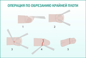 заниматься сексом после обрезания