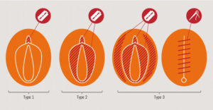 обрезание у женщин схема