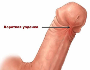 где уздечка на члене